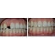 thumbnail image 3 of Reparación de encías con dientes sólidos Brackets caseros para dentaduras postizas Brackets de vampiro Brackets de tigre, 3 of 5