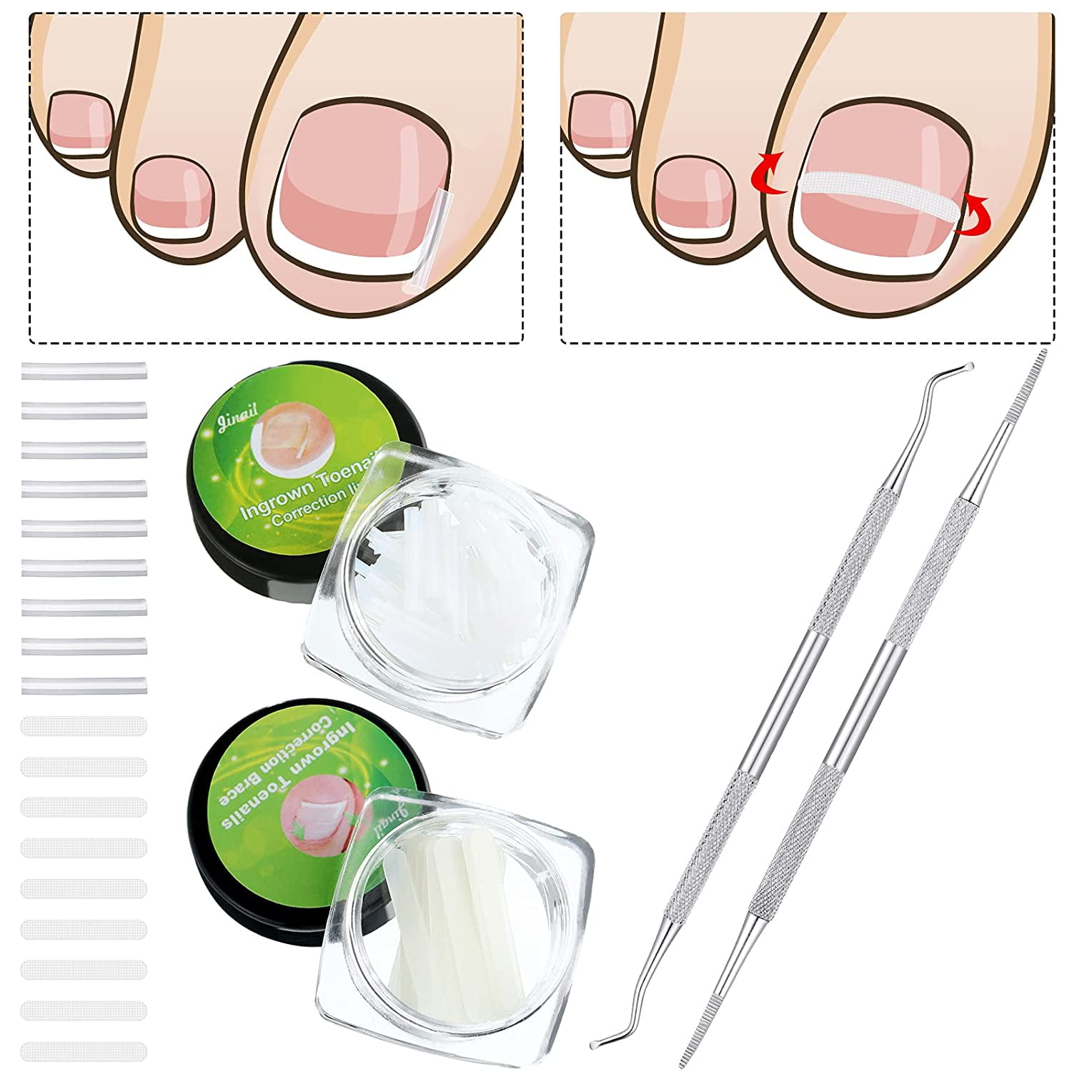100 Pieces Ingrown Toenail Corrector Strips with 2 Pieces Ingrown