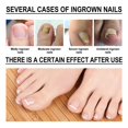 thumbnail image 3 of Esencia para uñas encarnadas de 10ml, esencia para tratamiento de uñas Unisex, cuidado de la salud de las uñas Likrtyny  Cuidado Belleza, 3 of 9