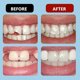 thumbnail image 3 of Dentures False Teeth, Clip on Veneers Top and Bottom, Temporary Adjustable Snap on Dentures Clip, 3 of 5