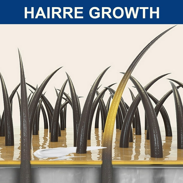 Alopecia Areata Cream Relieves Hair Loss and Activates Hair