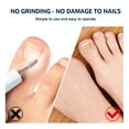 thumbnail image 4 of Nail Patches,Ingrown Toenail Correction Treatment Tool, No Glue 50Pcs Ingrown Toe nail Corrector Patch, Professional Ingrown Toenail Sticker, 4 of 8