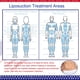thumbnail image 5 of Almohadillas de lipoespuma KUSMOO para tablas abdominales después de la cirugía, paquete de 5, 5 of 5