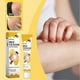 thumbnail image 2 of portable anti-itch cream for vitiligo skin care, 2 of 5