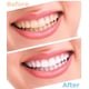 thumbnail image 2 of Dispositivo para blanquear los dientes, Gel dental de 3ml, juego de dispositivos para blanquear los dientes individuales JM, 2 of 3