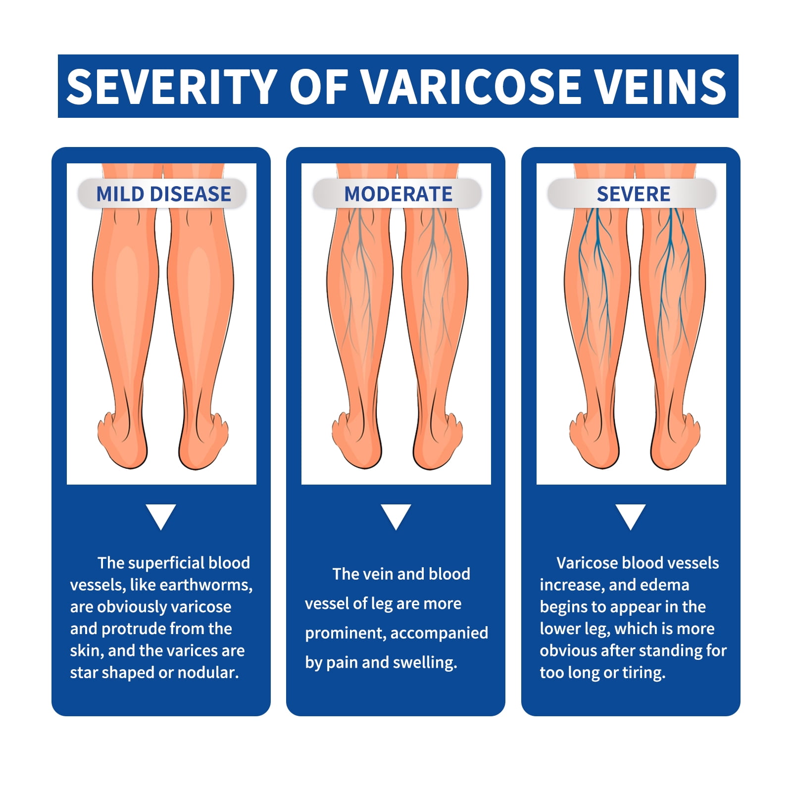 Alvantor Veins Cream for Leg Spider Vein Treatment with Rosemary Oil & Moisturizing Massage, 0.71oz