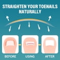 thumbnail image 3 of Ingrown Toenail Treatment, Ingrown Toenail Corrector Patch, Titanium Alloy Ingrown Toenail Care Kit for Curly Nail Support, 3 of 8
