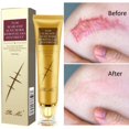 thumbnail image 2 of Crema para eliminar cicatrices de acne CAIROYAR ✅30g, 2 of 7