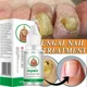 thumbnail image 5 of Suero para tratamiento de hongos en las uñas, productos de reparación de hongos en los dedos, Gel de eliminación para el cuidado de los pies y manos, antiinfección, onicomicosis, paroniquia, 5 of 5
