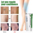 thumbnail image 1 of YIWUMI Varicose Cold Compress Gel Set, 1 of 1