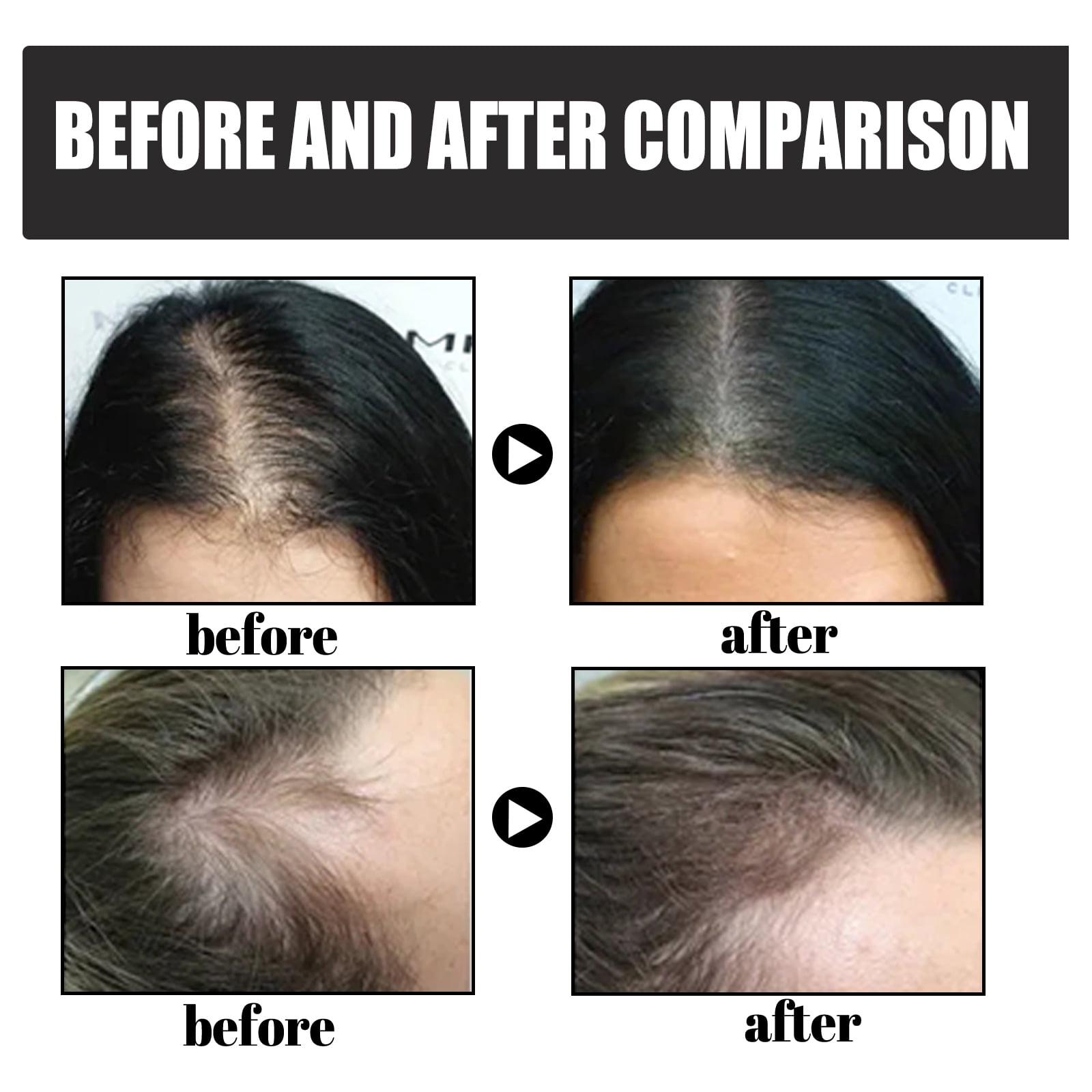 Alvantor Hair Building Fibers Powder for Thinning Hair, Instantly Thicker Fuller Look Hair Loss Concealer for Men Women, Medium Brown 0.42oz