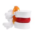 thumbnail image 1 of MasteelfCA 1pc Human Spine Model Lumbar Disc Herniation Presentation Model for School, 1 of 7