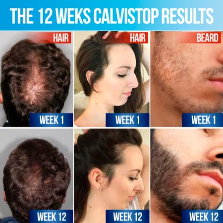 CalviStop, Tratamiento Anticaída del Cabello, Tónico para Detener y Tratar la Caída del Cabello con Baicapil, Frasco de 4 Onzas, 1 Frasco con su Aplicador