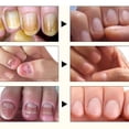 thumbnail image 3 of Suero para tratamiento de hongos en las uñas, esencia reparadora de pies, Gel para eliminación de hongos en las uñas de los pies, crema antiinfección para paroniquia y onicomicosis, 10ML, 3 of 4