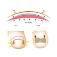 thumbnail image 3 of 50pcs Ingrown Toenail Corrector Stickers With Double Sided Tape Paronychia Corrector Pedicure Tools, 3 of 8