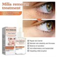 thumbnail image 4 of Éliminateur de Milium - Dissout & Réduit Milium, Whitehead, Hyperplasia Sébacé - 30ml, 4 of 5