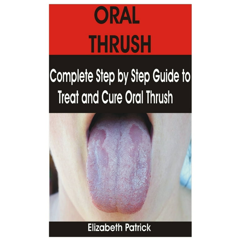 Oral Candidiasis Treatment