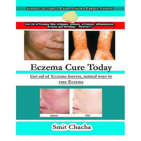 Eczema Cure Today: Get Rid of Eczema Forever, Natural Ways to Cure Eczema -
