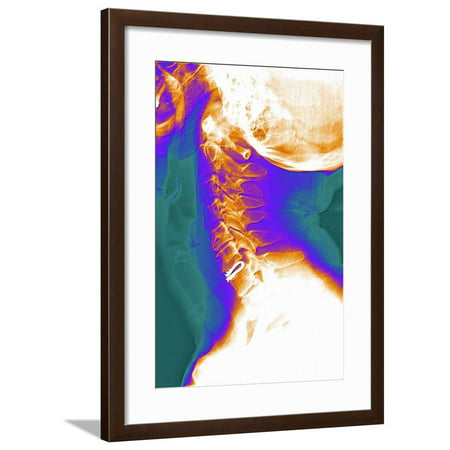 Artificial Cervical Disc, X-ray Framed Print Wall Art By