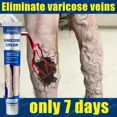 thumbnail image 2 of Ungüento de hierbas naturales para aliviar la fatiga de las venas varicosas, ungüento eficaz para eliminar la Vasculitis, flebitis, pata de araña, 2 of 5