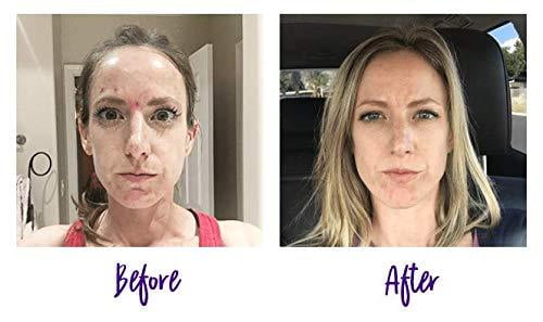 nxn acne edit cleanser