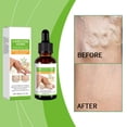 thumbnail image 2 of Clearance Aceites esenciales Elementos esenciales para el hogar Aceite para masaje de venas varicosas,aceites esenciales para masaje de venas varicosas y venas rojas,30ml(Buy 2 Get 1 Free), 2 of 7