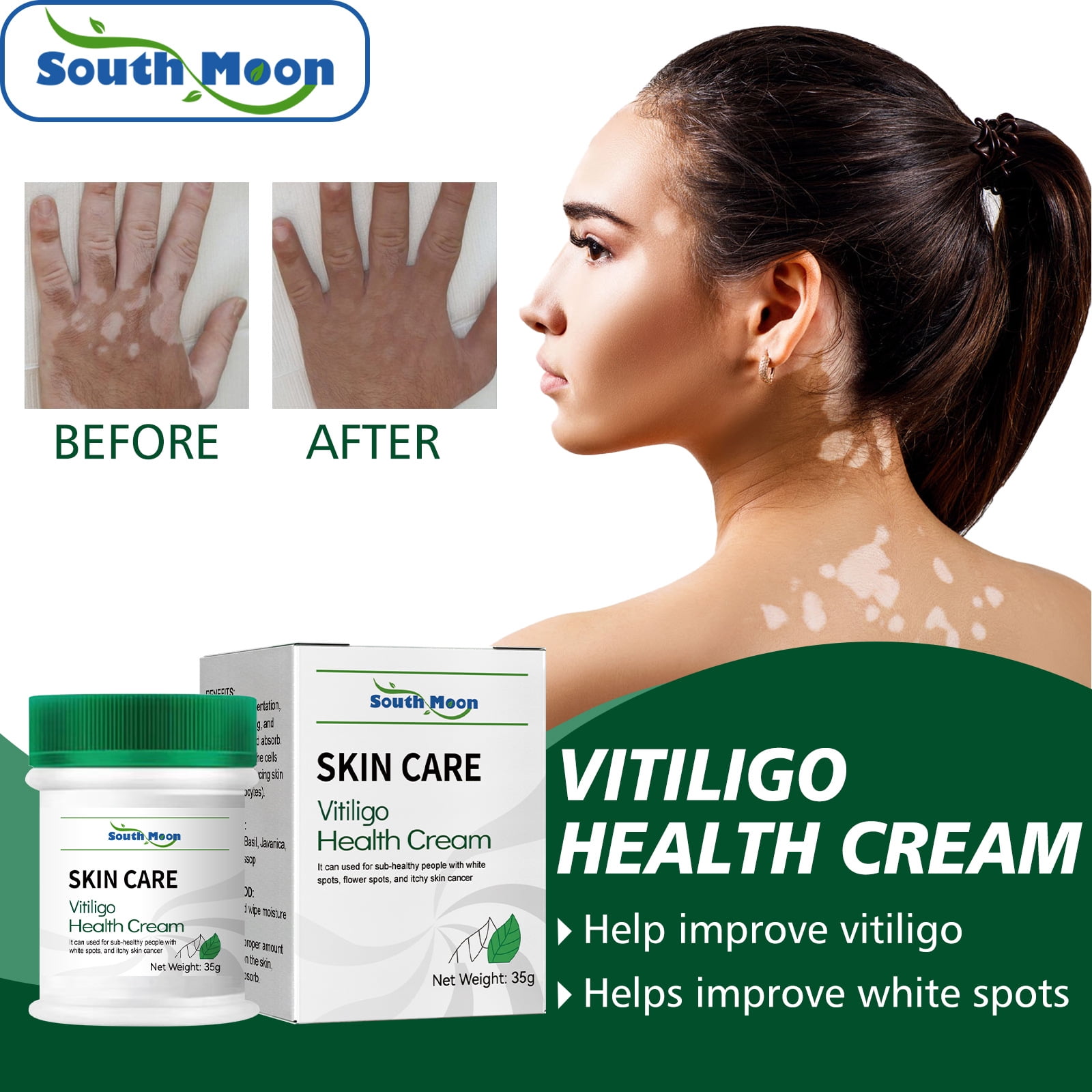 Vitiligo Cream, Vitiligo Treatment For Skin Vitiligo, Vitiligo Health Cream For Reduce White