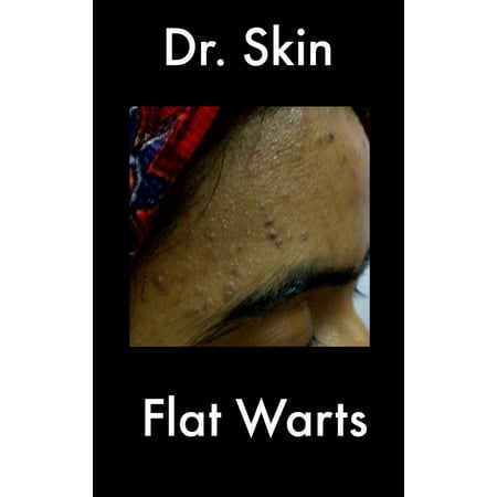 Flat Warts - eBook (Best Way To Get Rid Of Flat Warts)