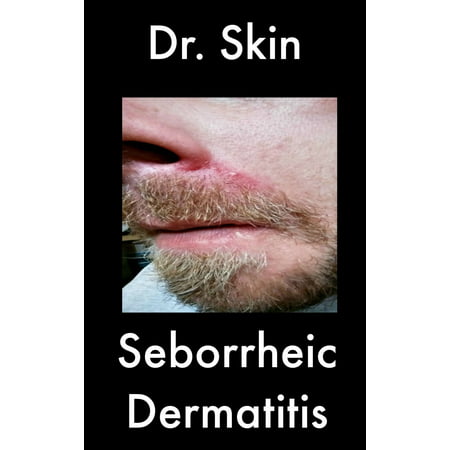 Seborrheic Dermatitis - eBook