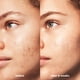 thumbnail image 5 of Sérum e.l.f. SKIN Blemish Breakthrough Triple-Acid Rejuvenaging, 5 of 6