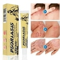 thumbnail image 2 of Crema para el tratamiento de la dermatitis,eczema y psoriasis,20 g,crema antipicazón para el cuidado de la piel,1 unidad, 2 of 5