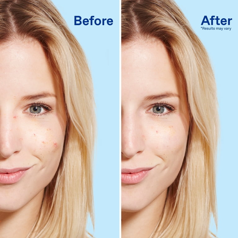 Daily Deep Cleanser for Acne-Prone Skin with Benzoyl Peroxide photo 5
