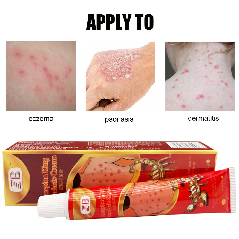 Antibacterial Antiitch Psoriasis Cream Dermatiti Eczematoid Hand Tinea