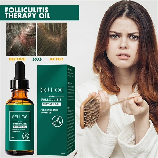 Aceite para la foliculitis del cuero cabelludo, aceite capilar, aceite natural para cabello y cuero cabelludo, nutritivo para puntas abiertas y cuero cabelludo seco para todo tipo de cabello 30 ml Ese