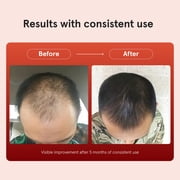 Keeps Minoxidil Solution 5% for Men - Topical Hair Regrowth - 3 Month Supply (3 x 2 fl oz Bottles)