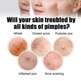 thumbnail image 3 of Large Capacity Pimple Patches, Colorful Cute Zit Covers,Hydrocolloid Acne Patches With Tea Oil, Witch Hazel, Centella Asiatica , Hyaluronic Sour, 3 of 4