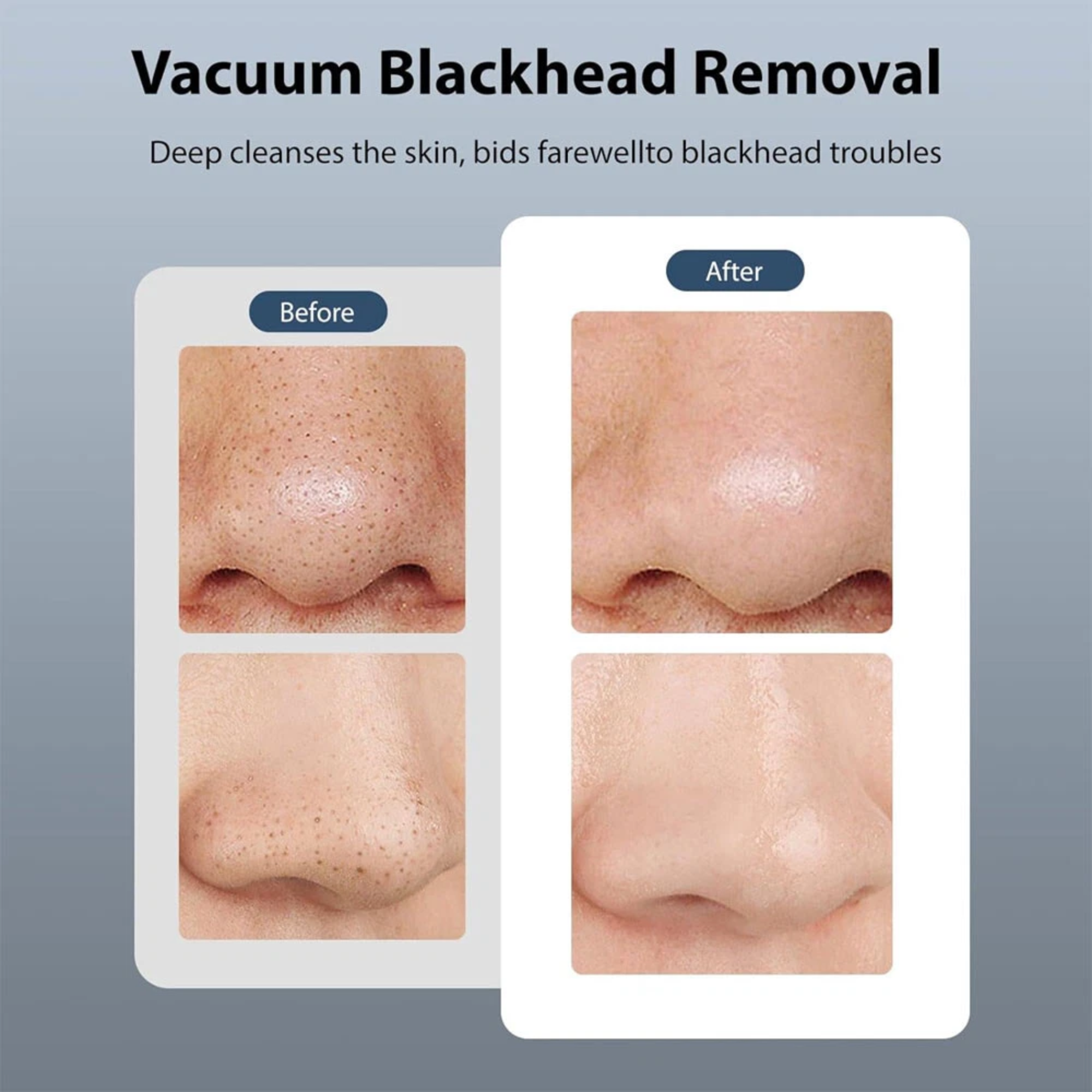 Vibeat 5-in-1 Blackhead Remover Vacuum, Facial Pore Cleanser Device with Warming & Icing, Spa Facial Tool at Home