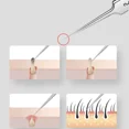 thumbnail image 3 of Alemán Ultrafino No. Pinzas con Clip para espinillas y espinillas, 5 celdas, salón de belleza, artefacto especial para raspar y cerrar, herramienta de aguja para acné, 3 of 5
