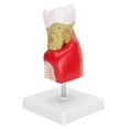thumbnail image 1 of Modèle de Dents Caries Dentaires Modèle de Dents Dentaires pour Enseignement Formation Patient Éducation, 1 of 13