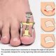 thumbnail image 3 of Ingrown Toenail Removal Kit, Ingrown Toenail Corrector, Ingrown Toenail Tool Kit, Ingrown Toenail Treatment Kit, Ingrown Toenail Corrector Strips, 3 of 5