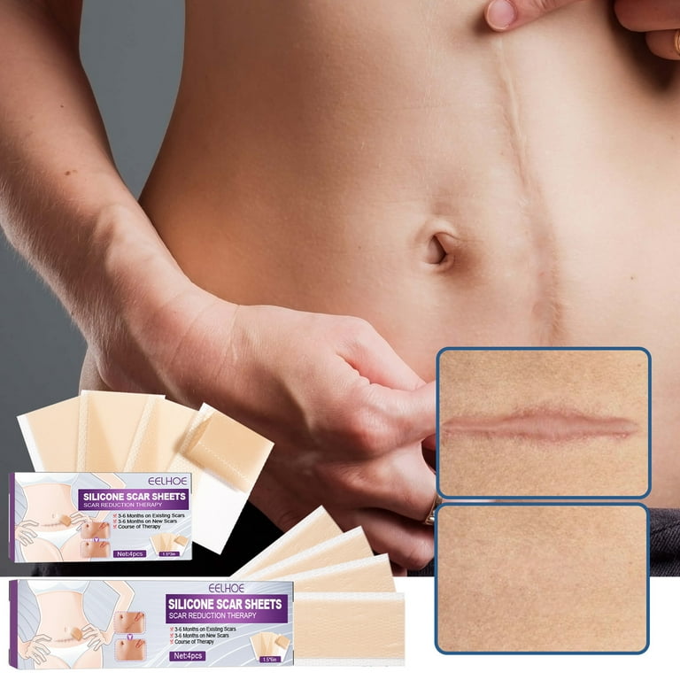 Scar reduction 2024 silicone sheets