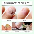thumbnail image 4 of 7-Day Tea Tree Ginger Nail Fungus Treatment Nail Renewal Liquid Strengthening for Damaged & Toenails, 4 of 5