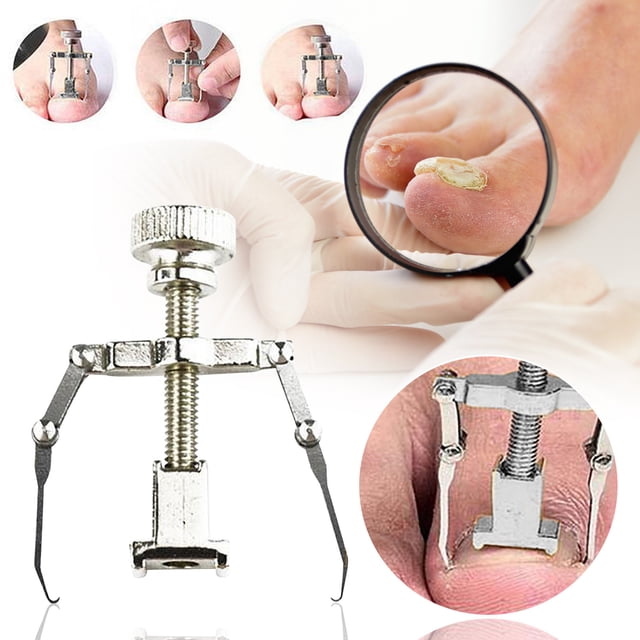 Fiudx Corrector de Dedos, Hermético Ajustable para de Alineación de Uñas, Fijador de Uñas Encarnadas de Acero Inoxidable, Solución de Los Pies, Uso Diario En Pedicura, Tratamiento En Casa, Proceso de