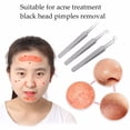 thumbnail image 2 of 1 Pc Blackhead Tweezers Blackhead Blemishs Point Bend Gib Head Comedone Acne Face SkinCare Tools, 2 of 6