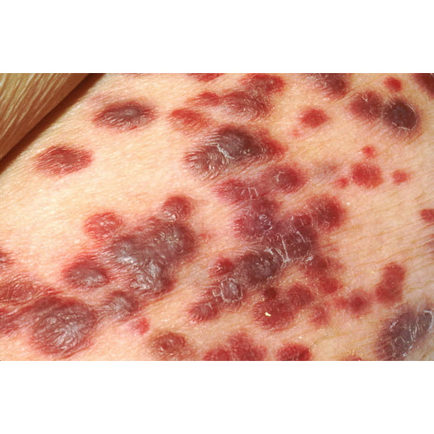 Top 104+ Images pictures of kaposi’s sarcoma skin Updated