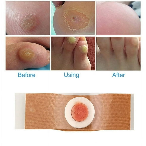 YOPTOP 12Pcs/Set Foot Corn Remover Foot Pad Patches Removal Fast Recovering,none,none