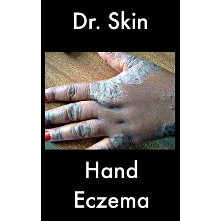 Hand Eczema - eBook (Best Way To Treat Eczema On Hands)