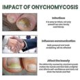 thumbnail image 5 of 3pcs EELHOE Anti Fungal Treatment Fungus Effective Finger Toe Nail Repair Liquid Solution -, 5 of 5