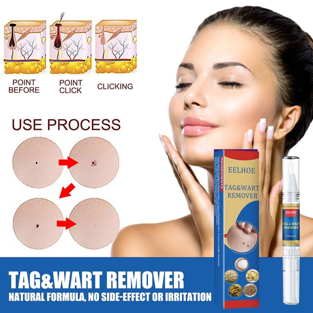 Removedor de verrugas Skin Tag Pen Professional Papillomas Moles Removal Pen (02) Ndcxsfigh Nuevos Originales