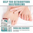 thumbnail image 5 of 10ml Fungal Nail Treatment Nail Foot Whitening Toe Fungus Removal Feet Care Repair Nail For O, 5 of 5